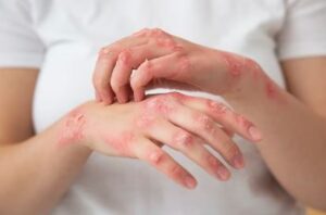 Las 7 mejores cremas para la dermatitis atópica Guía de recomendaciones