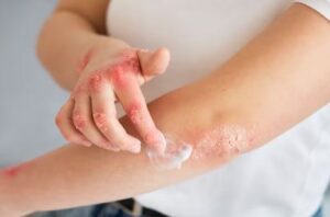 Por qué es importante la crema para la dermatitis atópica